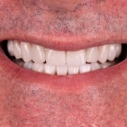 o melhor protocolo de implante dentário você encontra na Humaniza Odontologia