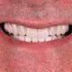 o melhor protocolo de implante dentário você encontra na Humaniza Odontologia