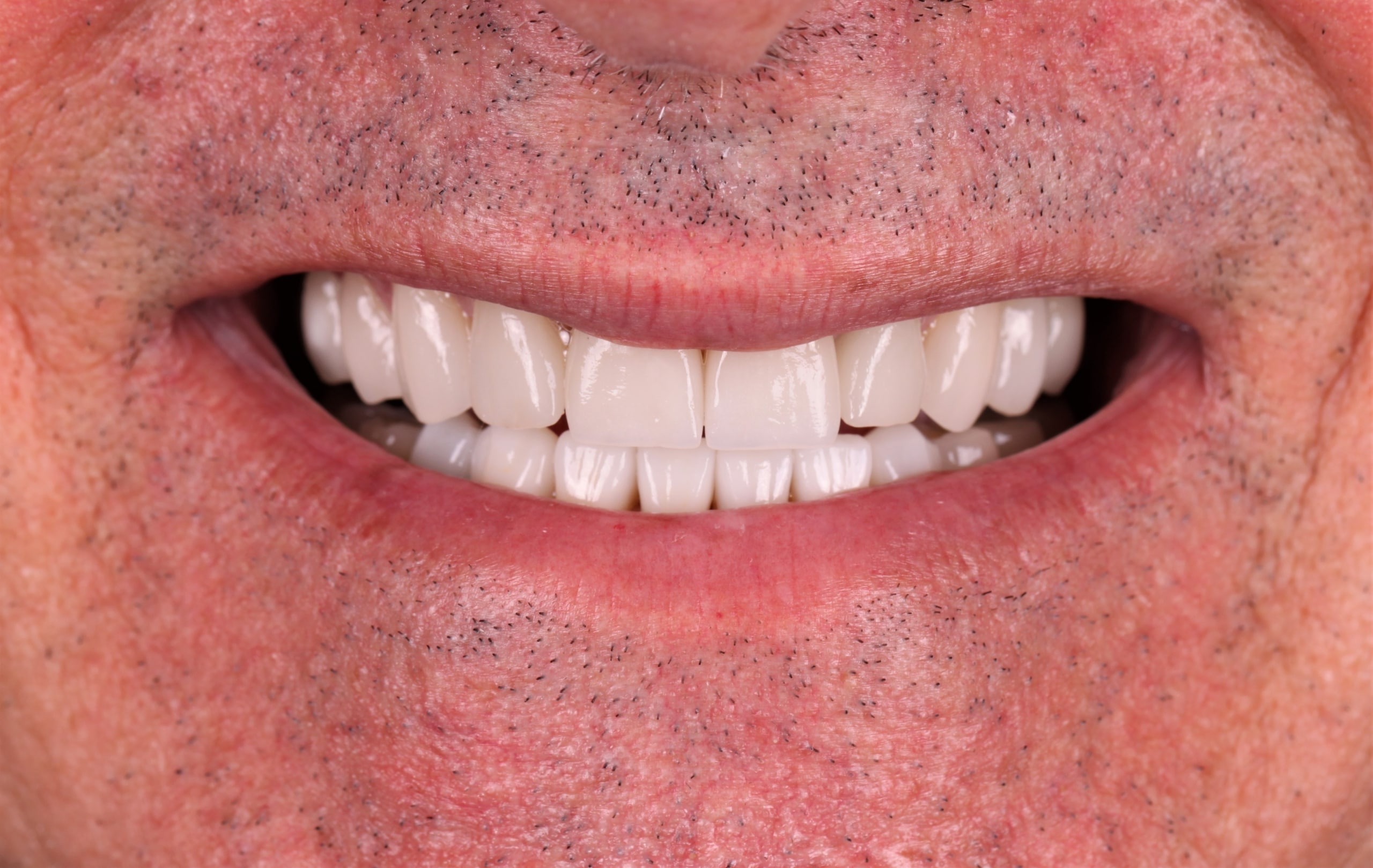 o melhor protocolo de implante dentário você encontra na Humaniza Odontologia