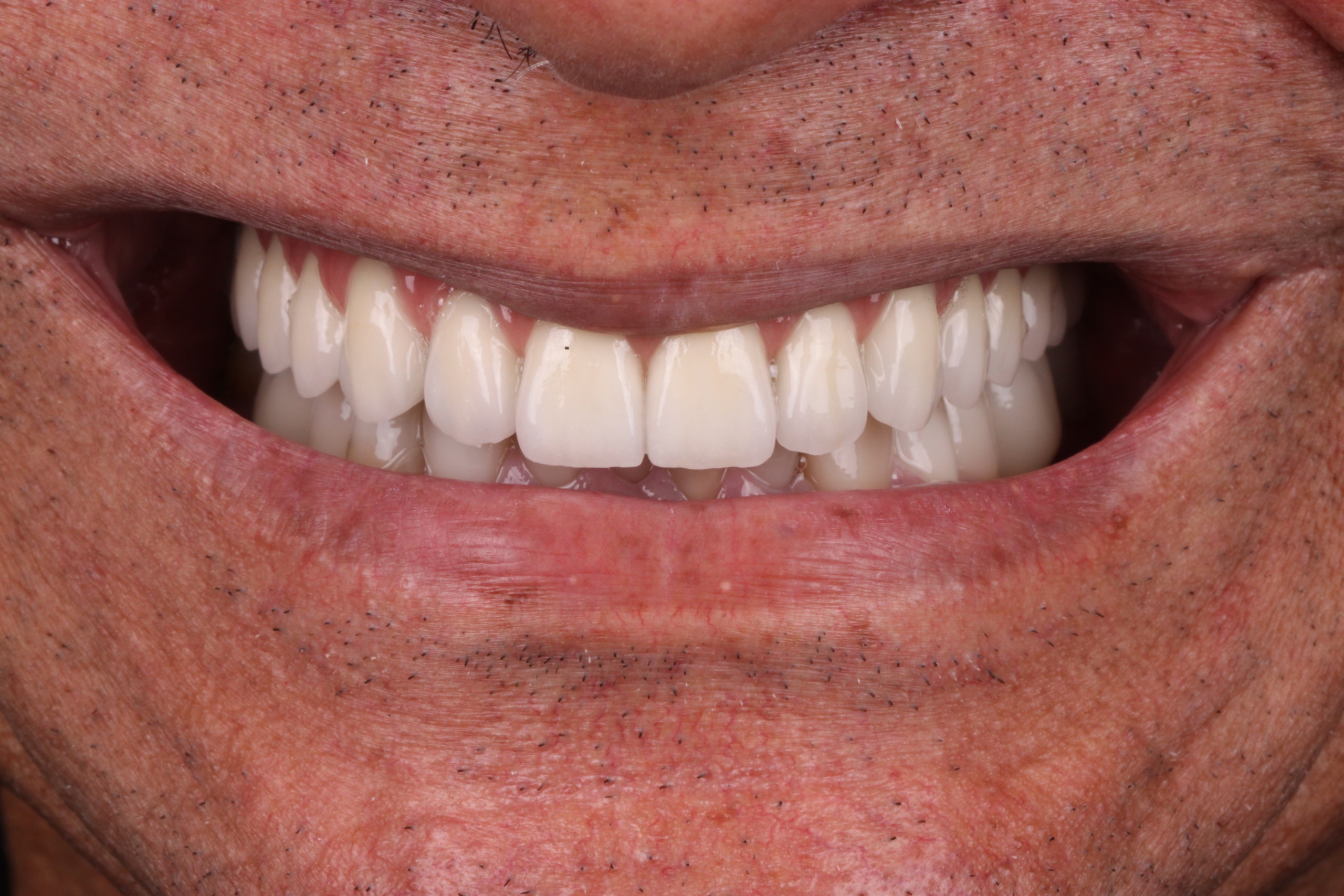 Sorriso renovado com implantes realizados pela Humaniza Odontologia, sorriso do paciente após finalização do tratamento.