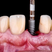 O Implante dentário trás inúmeros benefícios. além da estética melhora a mastigação, fala, deglutição e toda a qualidade de vida.