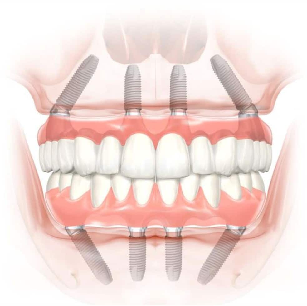 O Protocolo All On 4 é fixado nos ossos da mandíbula com 4 pinos.