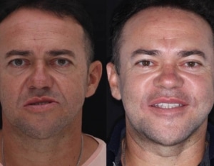 antes e depois da Cirurgia maxilar