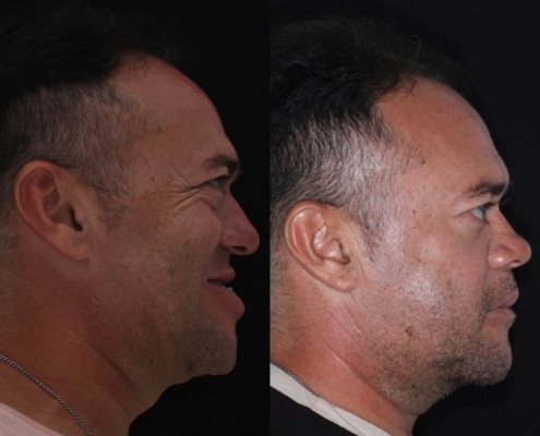 antes e depois da Cirurgia maxilar