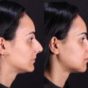Cirurgia ortognática